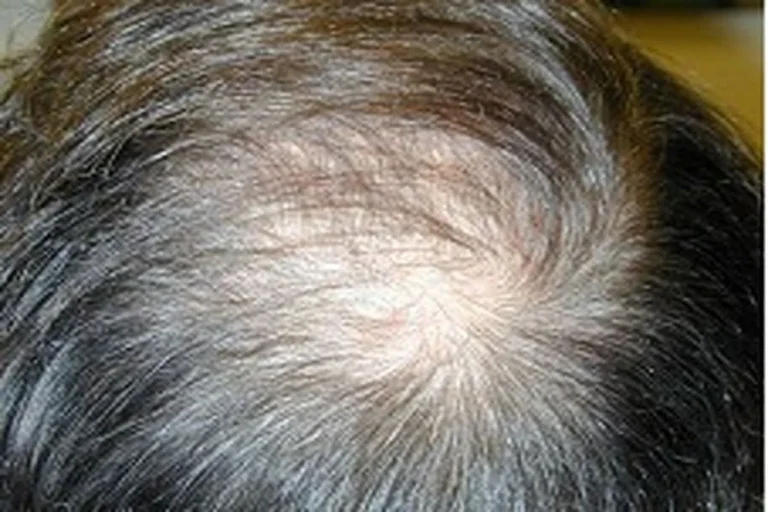 آیا ریزش مو در سن کم معمول است؟
