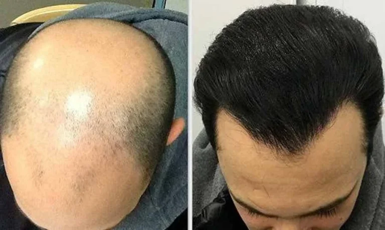 10 مرکز معتبر کاشت مو در ستارخان + مشاوره