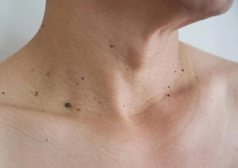 چه نوع زگیل تناسلی خطرناک است؟
