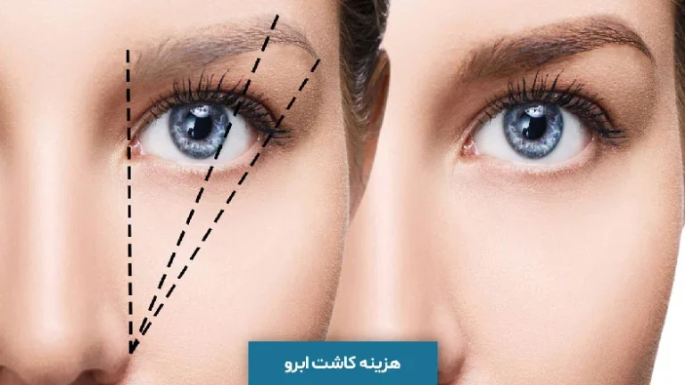هزینه روش های مختلف کاشت ابرو در تهران