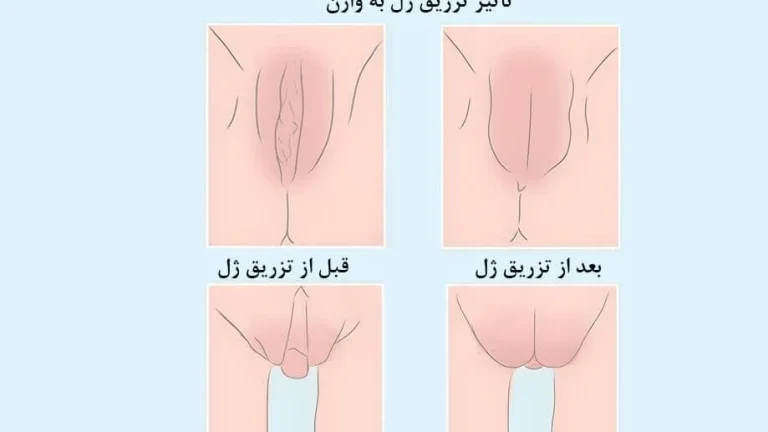 آیا تزریق ژل به واژن عوارض دارد؟