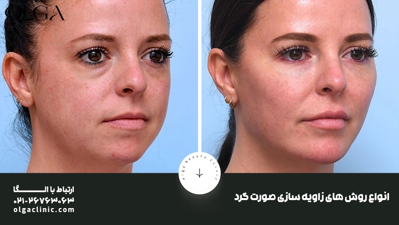 انواع روش های زاویه سازی صورت گرد